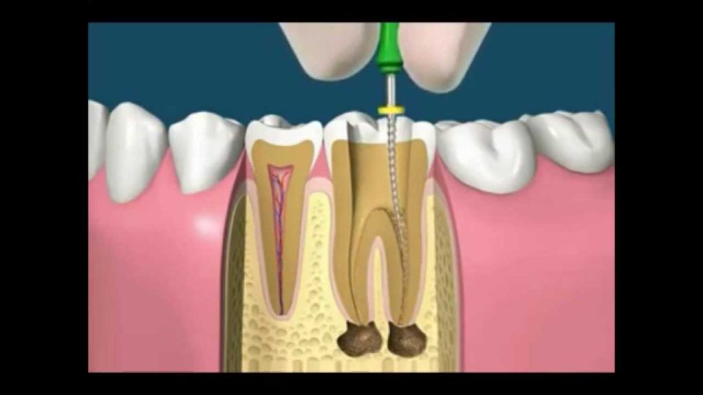 Endodontia tratamento de canal dentário Ortomix Odontologia Seu dentista em Brasília