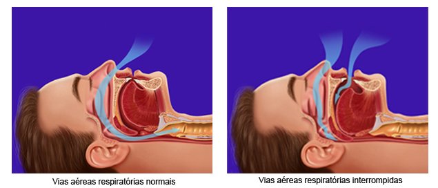 Para não morrer sufocado em seu sono