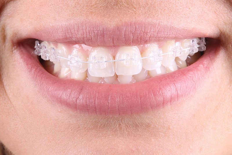 Ortodontia em Campinas  Aparelho Dentário Fixo ou Transparente